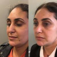 Dr Azan & Dr Susini -  Prix pour réaliser une intervention de rhinoplastie secondaire
