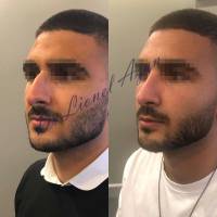 Institut de rhinoplastie à Bruxelles en Belgique