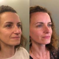 Dr Azan & Dr Susini -  Chirurgien ORL spécialisé en rhinoplastie