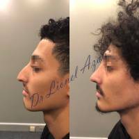 Dr Azan & Dr Susini -  Chirurgien ORL spécialisé en rhinoplastie