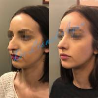 Institut de rhinoplastie à Lille dans le Nord