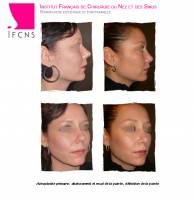 Dr Azan & Dr Susini -  Qui contacter à Bruxelles en Belgique pour la prise en charge d'une rhinoplastie secondaire ?