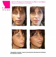 Institut de rhinoplastie à Lille dans le Nord