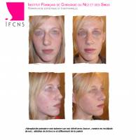 Institut de rhinoplastie à Paris en Île-de-France