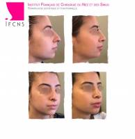 Dr Azan & Dr Susini -  Chirurgie en rhinoplastie ethnique pour un nez asiatique