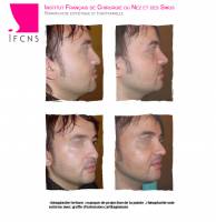 Dr Azan & Dr Susini -  Reconstruction d'un nez cassé par un chirurgien spécialisé