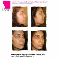 Institut de rhinoplastie à Genève en Suisse