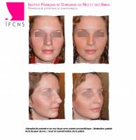 Dr Azan & Dr Susini -  Chirurgien esthétique pour se refaire le nez