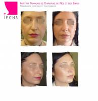 Dr Azan & Dr Susini -  Rhinoplastie ultrasonique pour la correction d'un nez cassé