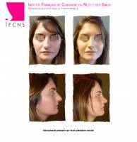 Institut de rhinoplastie à Bordeaux en Nouvelle-Aquitaine