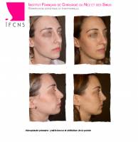 Institut de rhinoplastie à Lyon en Rhône-Alpes