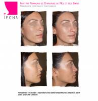 Dr Azan & Dr Susini -  Rhinoplastie ultrasonique pour la correction d'un nez cassé