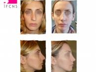 Institut de rhinoplastie à Paris en Île-de-France