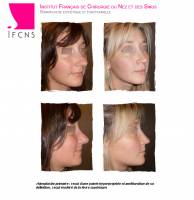 Dr Azan & Dr Susini -  Reconstruction d'un nez cassé par un chirurgien spécialisé