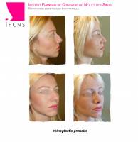 Institut de rhinoplastie à Lyon en Rhône-Alpes