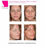 Dr Azan & Dr Susini -  Chirurgien à Lyon en Rhône-Alpes pour faire une septoplastie