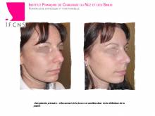 Dr Azan & Dr Susini -  Chirurgien à Paris en Île-de-France pour faire une septoplastie