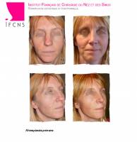 Institut de rhinoplastie à Bordeaux en Nouvelle-Aquitaine