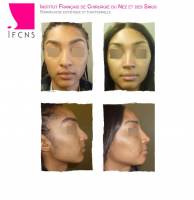 Institut de rhinoplastie à Paris en Île-de-France