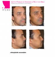 Institut de rhinoplastie à Paris en Île-de-France