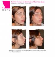 Institut de rhinoplastie à Bordeaux en Nouvelle-Aquitaine