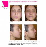 Dr Azan & Dr Susini -  Prix pour réaliser une intervention de rhinoplastie secondaire