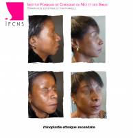 Dr Azan & Dr Susini -  Chirurgien spécialiste en rhinoplastie pour embellir son nez