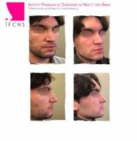 Institut de rhinoplastie à Genève en Suisse