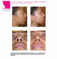 Dr Azan & Dr Susini -  Chirurgien à Lyon en Rhône-Alpes pour faire une septoplastie