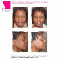 Dr Azan & Dr Susini -  Chirurgien ORL spécialisé en rhinoplastie