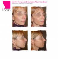 Institut de rhinoplastie à Bordeaux en Nouvelle-Aquitaine