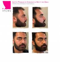 Institut de rhinoplastie à Bordeaux en Nouvelle-Aquitaine