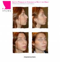 Institut de rhinoplastie à Bordeaux en Nouvelle-Aquitaine