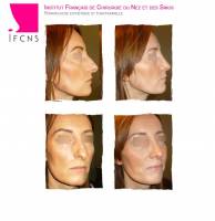 Institut de rhinoplastie à Lille dans le Nord