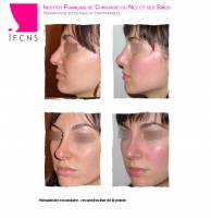 Institut de rhinoplastie à Bordeaux en Nouvelle-Aquitaine