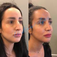 Institut de rhinoplastie à Bordeaux en Nouvelle-Aquitaine