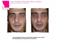 Institut de rhinoplastie à Paris en Île-de-France