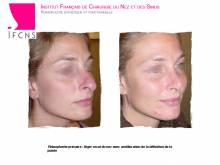 Dr Azan & Dr Susini -  Spécialiste en chirurgie esthétique du nez