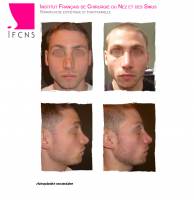Dr Azan & Dr Susini -  Consulter un chirurgien plastique pour une opération du nez