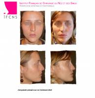 Institut de rhinoplastie à Paris en Île-de-France