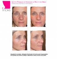 Dr Azan & Dr Susini -  Prix pour opérer un nez cassé