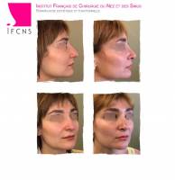 Dr Azan & Dr Susini -  Chirurgien plasticien pour un traumatisme nasal