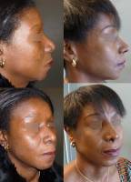 Dr Azan & Dr Susini -  Chirurgien plasticien pour remettre un nez droit