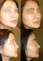 Dr Azan & Dr Susini -  Chirurgie en rhinoplastie ethnique pour un nez asiatique