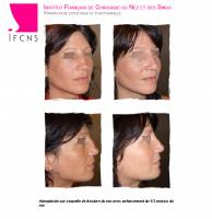 Dr Azan & Dr Susini -  Chirurgie en rhinoplastie pour une réduction des narines