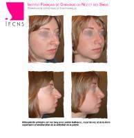 Institut de rhinoplastie à Bruxelles en Belgique