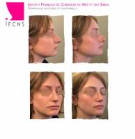 Institut de rhinoplastie à Paris en Île-de-France