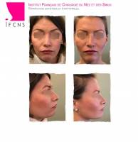 Institut de rhinoplastie à Genève en Suisse