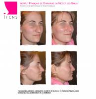 Institut de rhinoplastie à Genève en Suisse