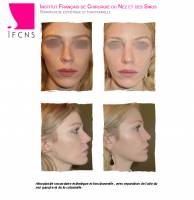 Institut de rhinoplastie à Bruxelles en Belgique